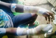Parent in Nyando burn son’s fingers over missing phone